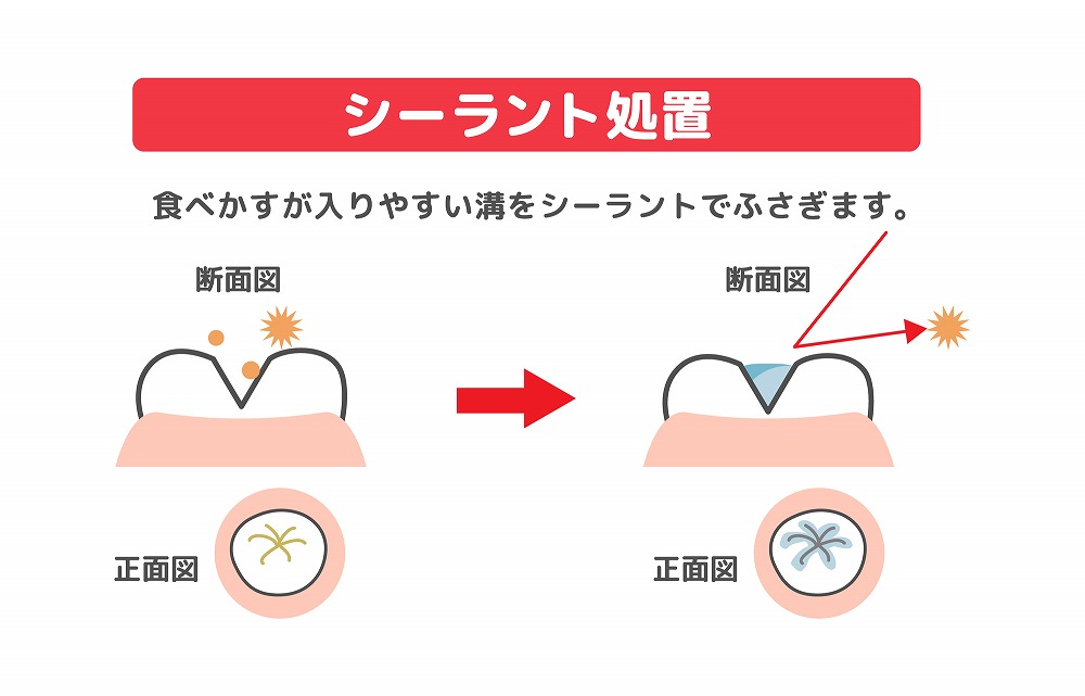 シーラントで虫歯予防