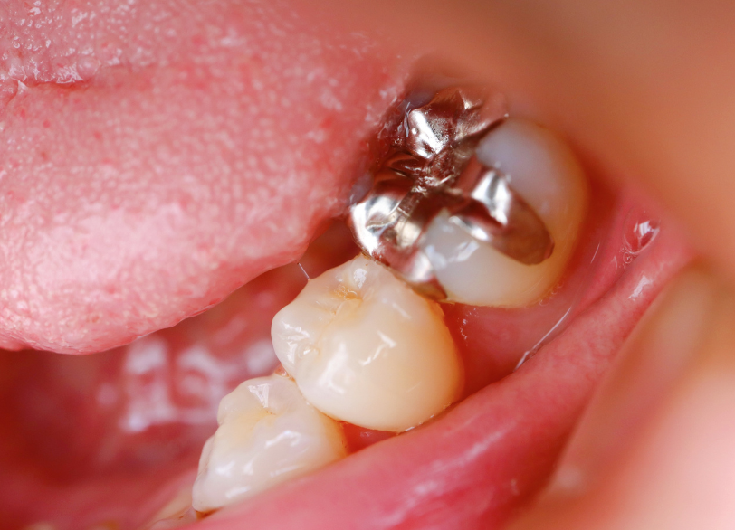 銀歯|あおやま歯科