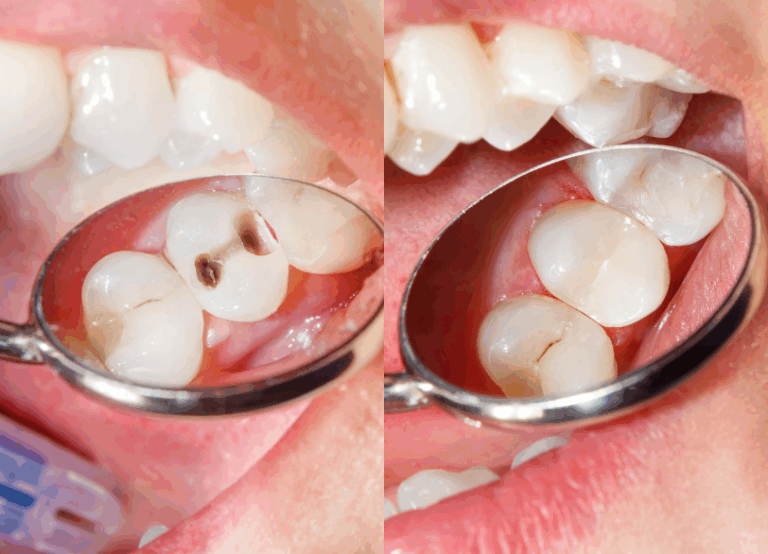 コンポジットレジン|あおやま歯科