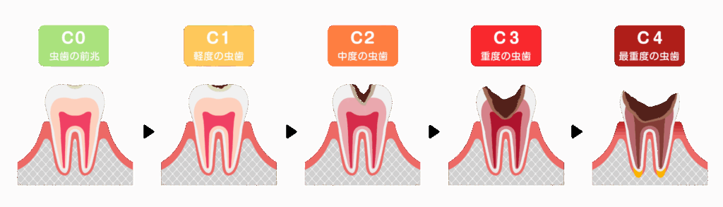 虫歯の進行段階|あおやま歯科