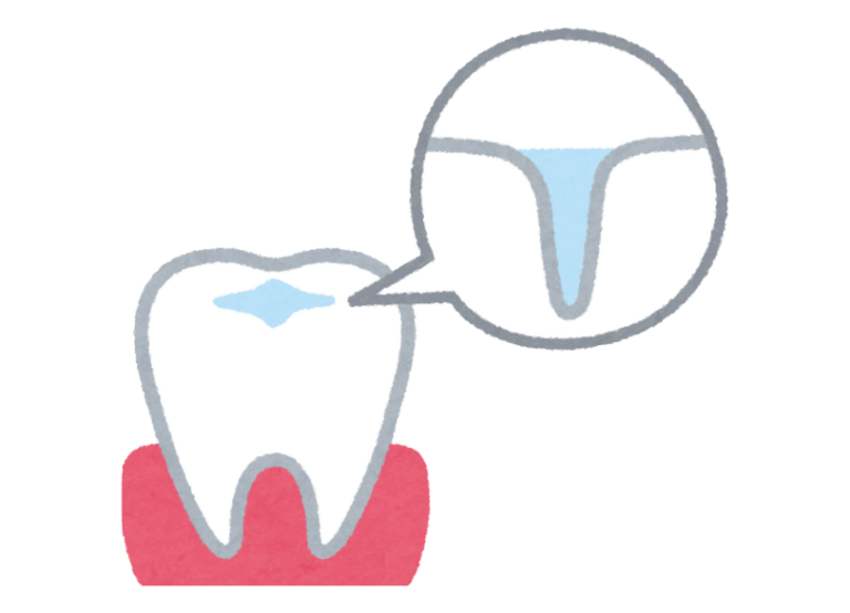 シーラント|あおやま歯科