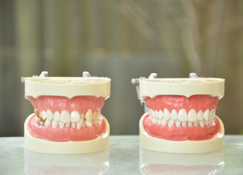 咀嚼機能の向上|あおやま歯科