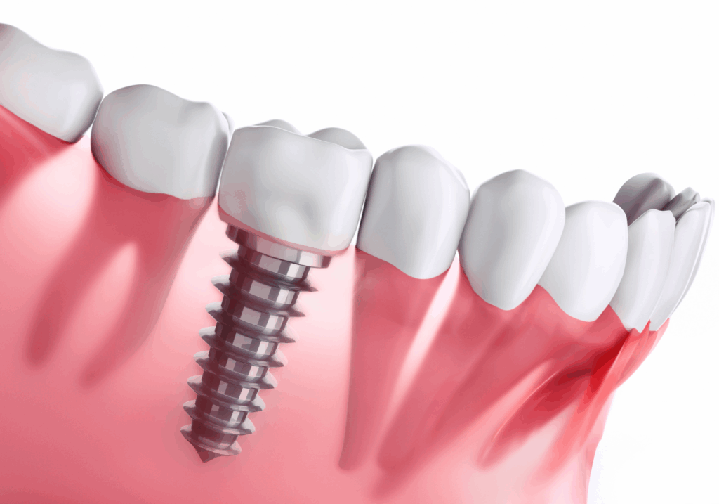 インプラントとは｜あおやま歯科