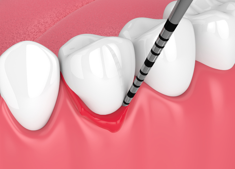 歯周病|あおやま歯科