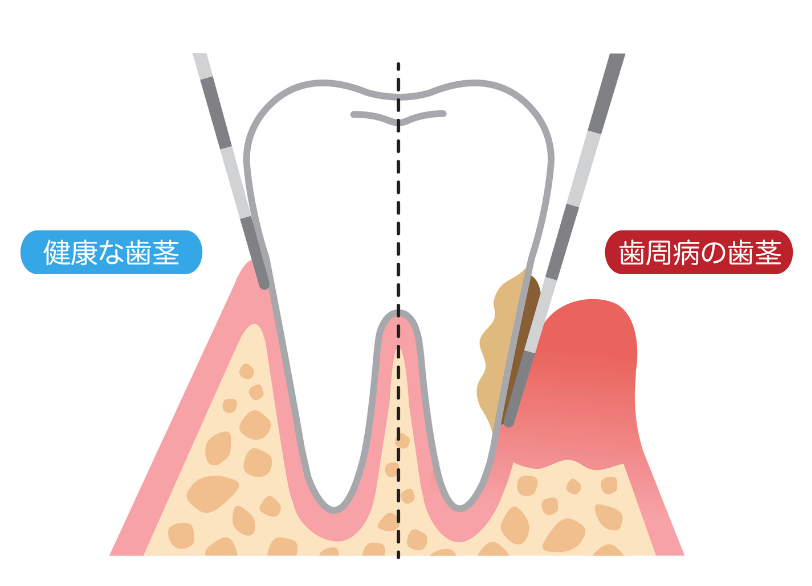 サイレント・ディジーズ|あおやま歯科