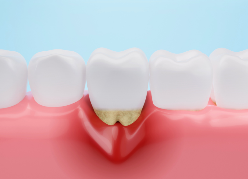 歯周組織再生療法|あおやま歯科