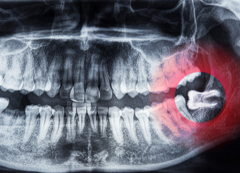 抜歯が勧められるケース｜あおやま歯科