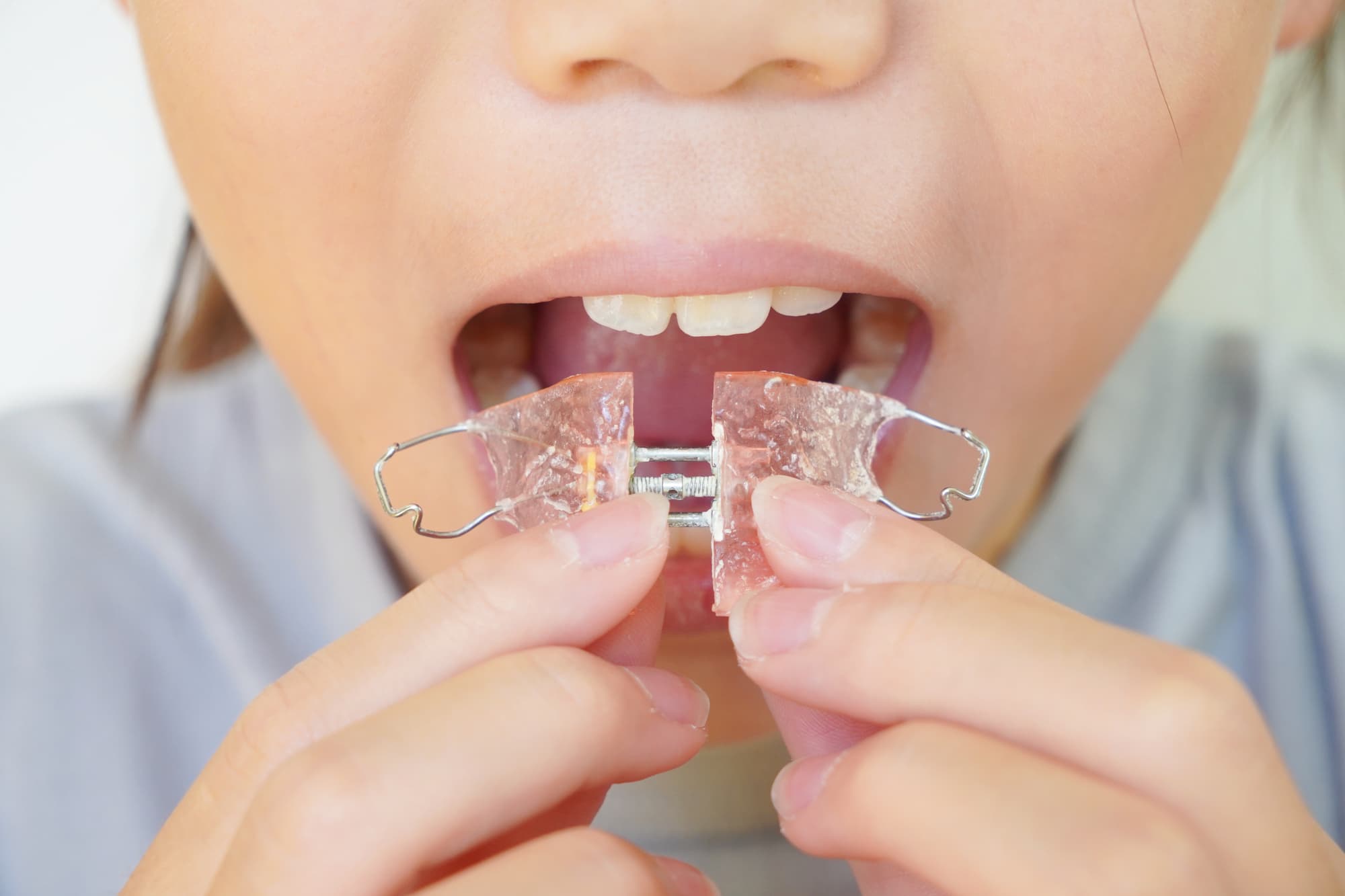 矯正の装置を装着しようとしている子どもの口元