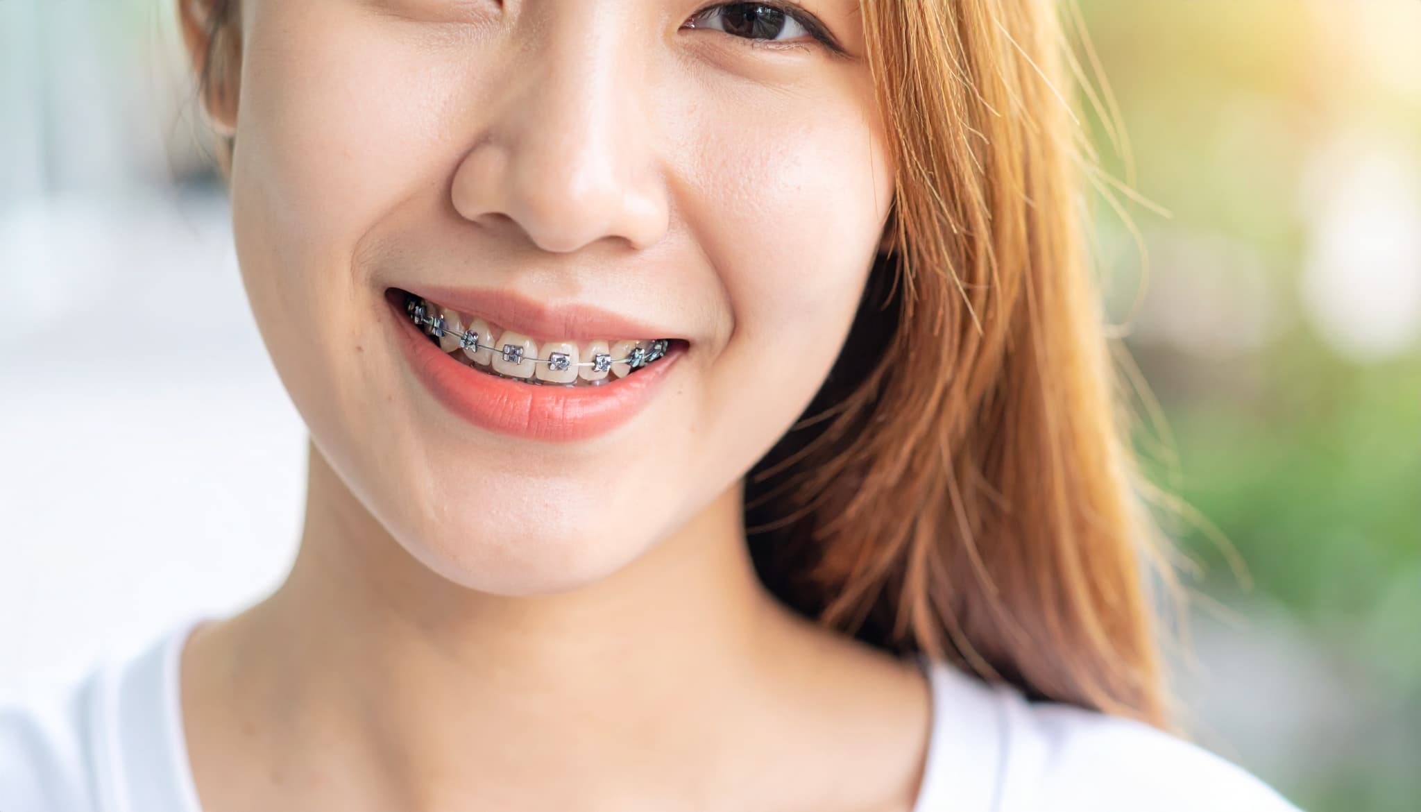 ワイヤー矯正をしている女性