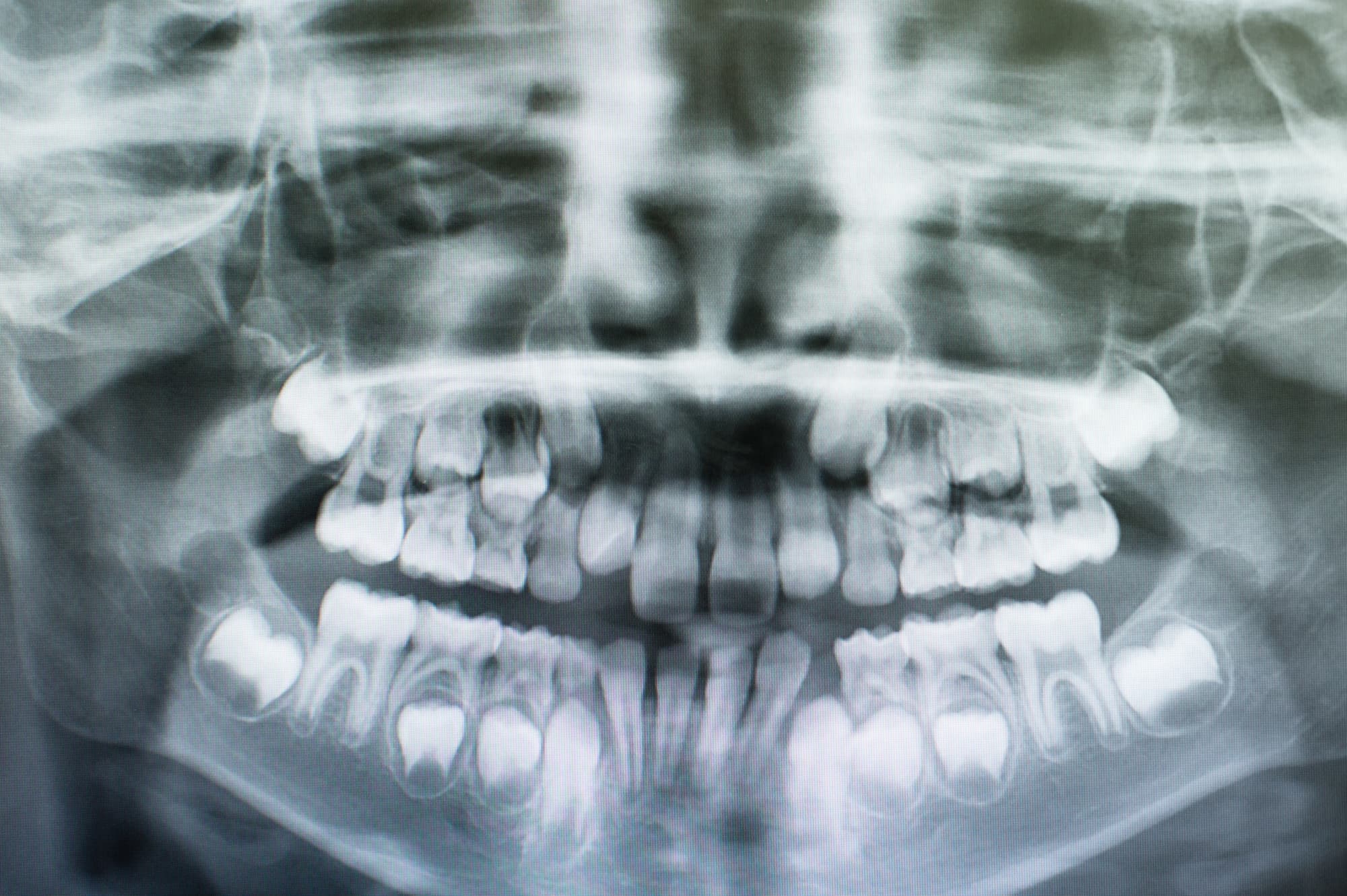 子どもの歯のレントゲン