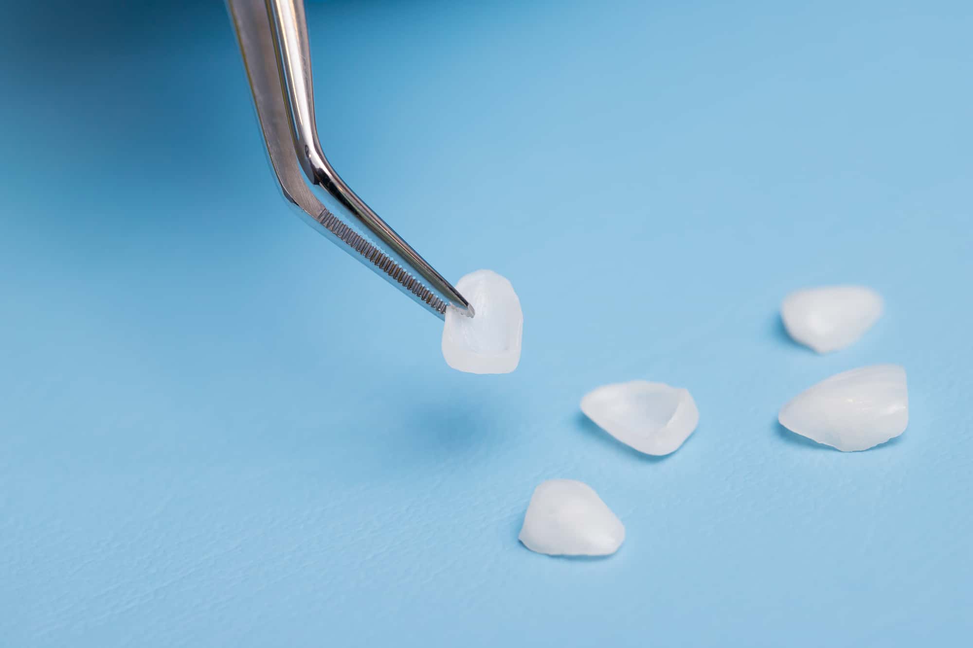 セラミック治療の一種であるラミネートべニアのイメージ