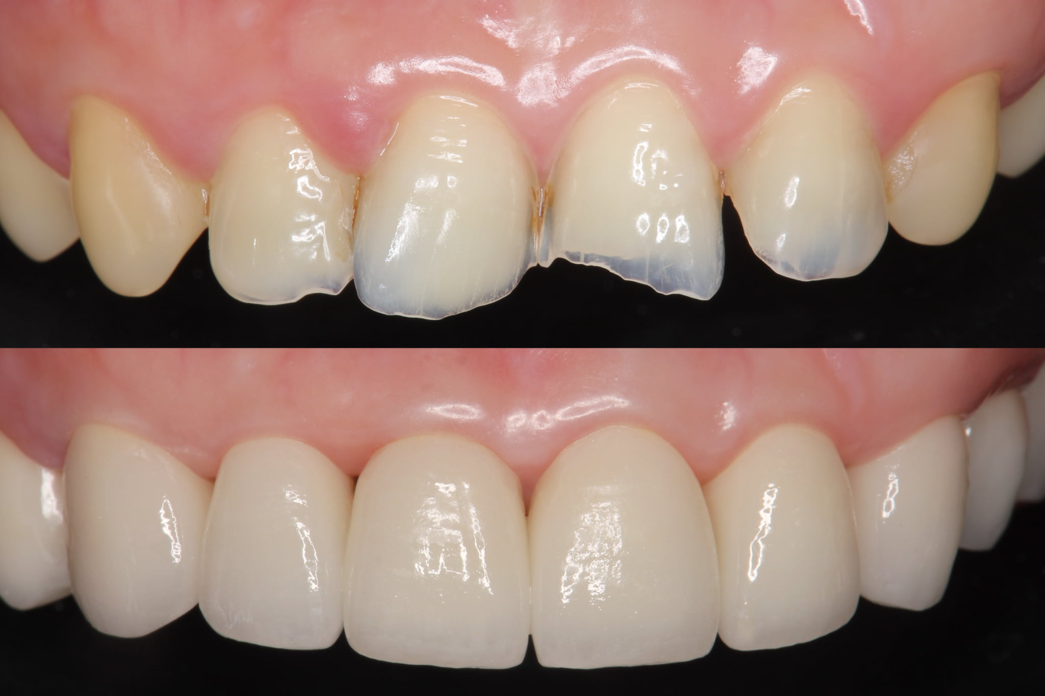 欠けた前歯をセラミック治療した前後のイメージ