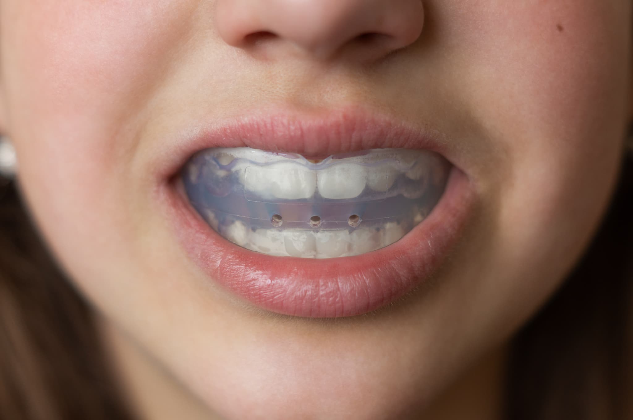 プレオルソを付けた口元