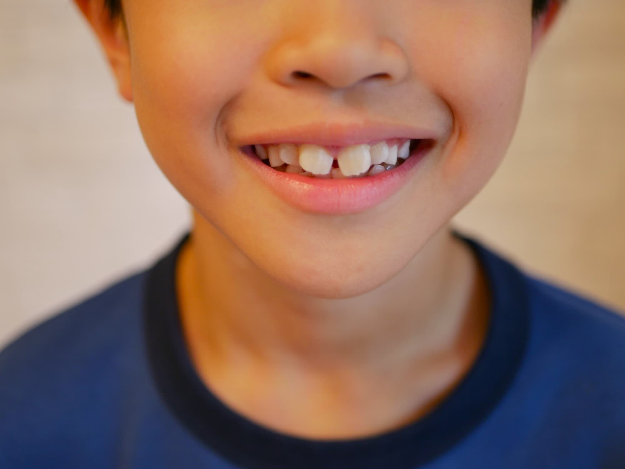 出っ歯の男の子