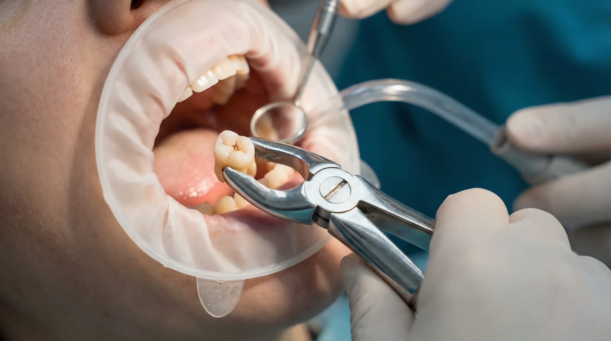 矯正のために抜歯する様子