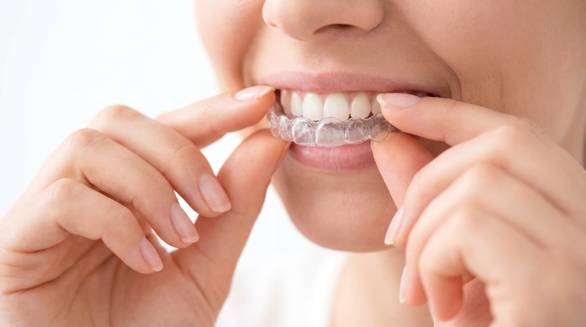 マウスピースを使用して顎関節症を治療する様子