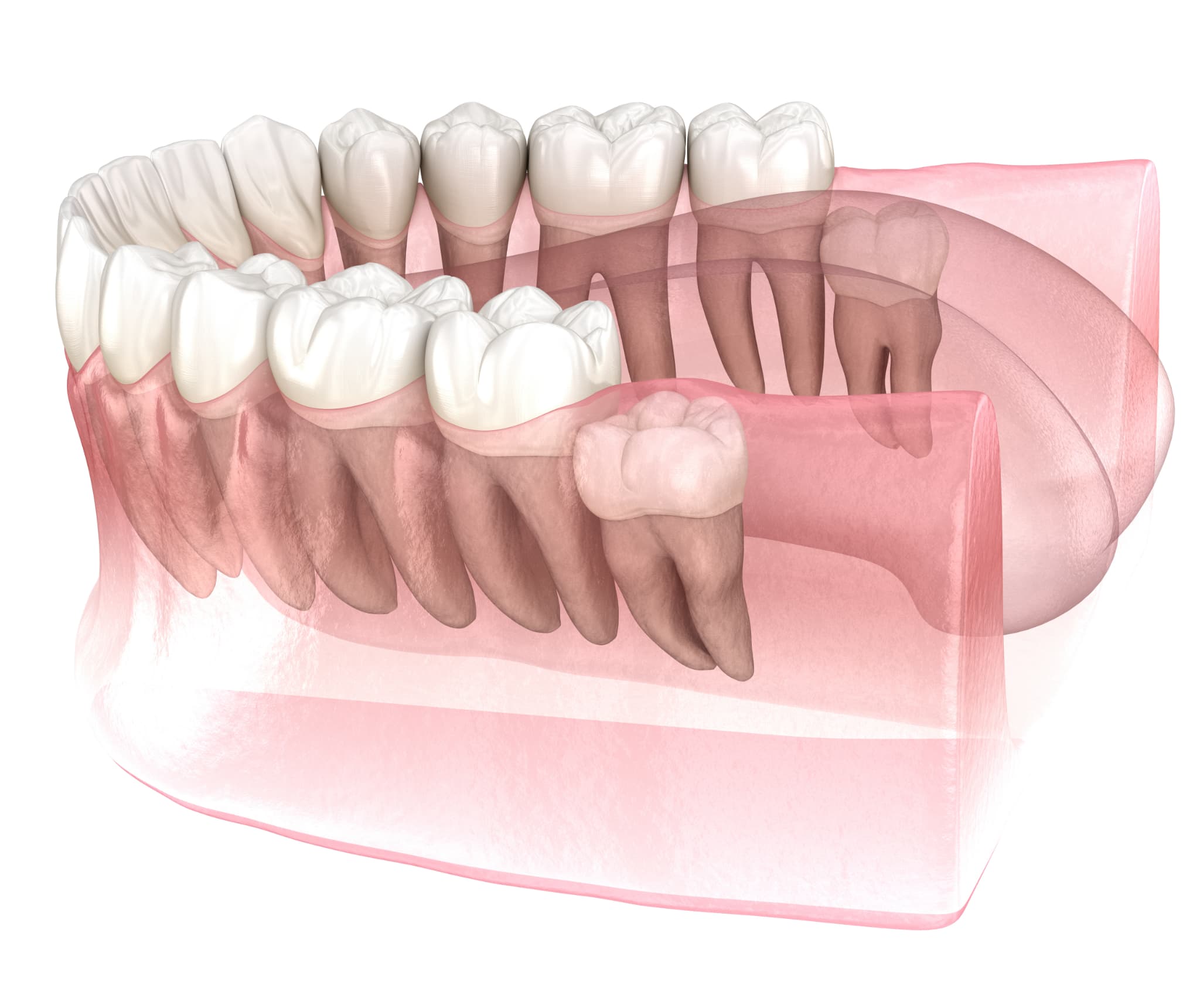 完全に埋まっている親知らずのイメージ
