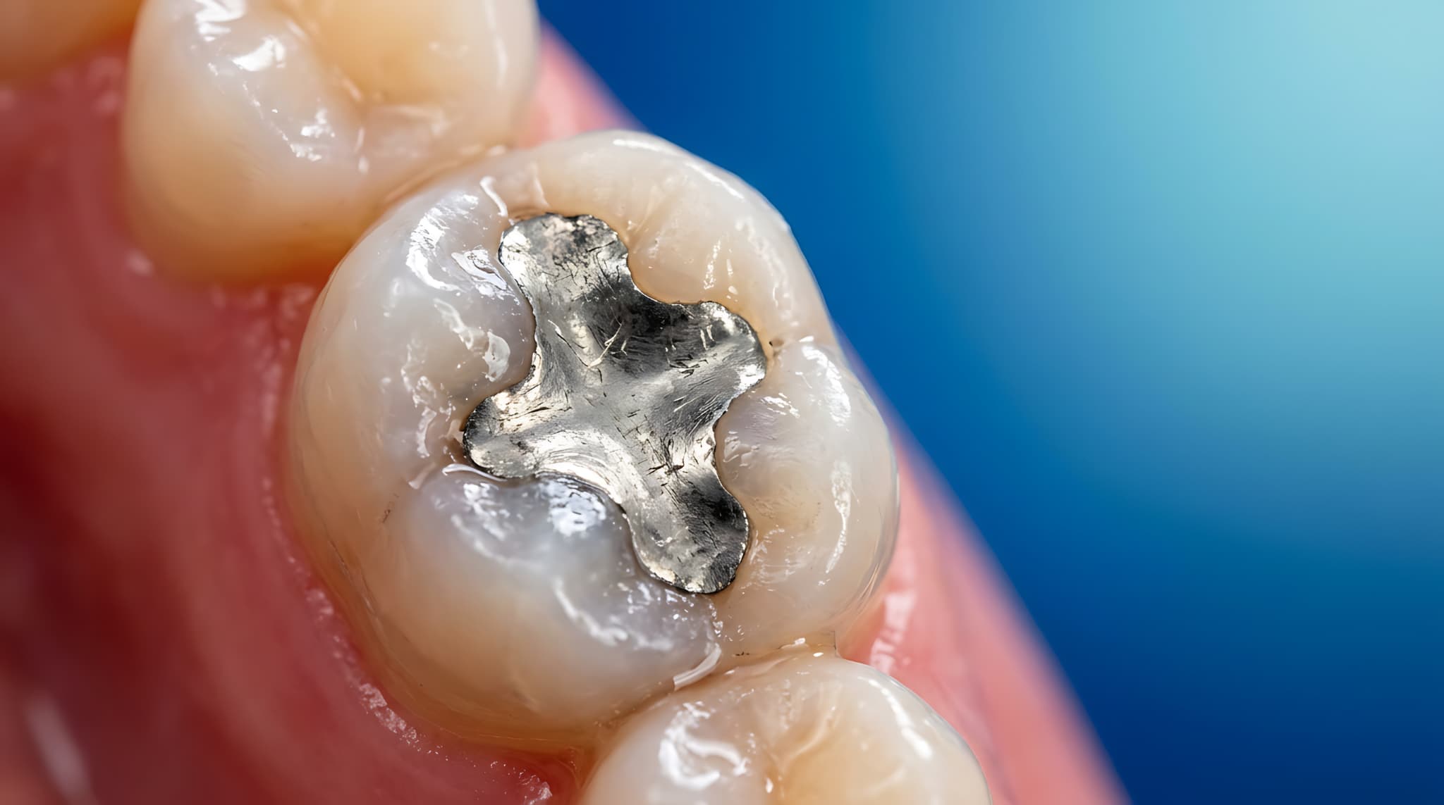 銀歯の詰め物で治療した歯